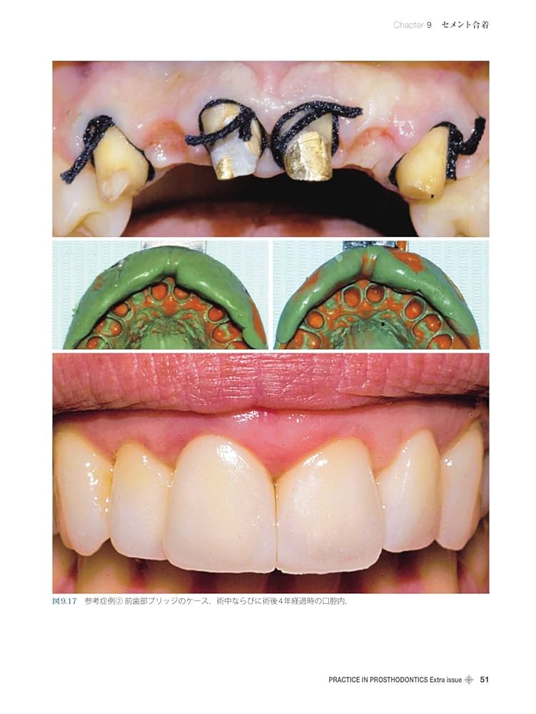 バーティカルプレパレーション 上下巻セット 補綴臨床別冊 バーティカルプレパレーション 下巻 B.O.P.T.